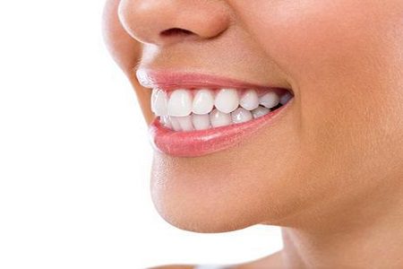 Smile Makeover