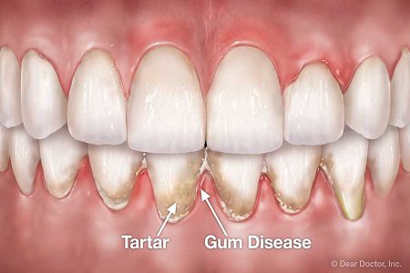 Periodontal Gum Disease